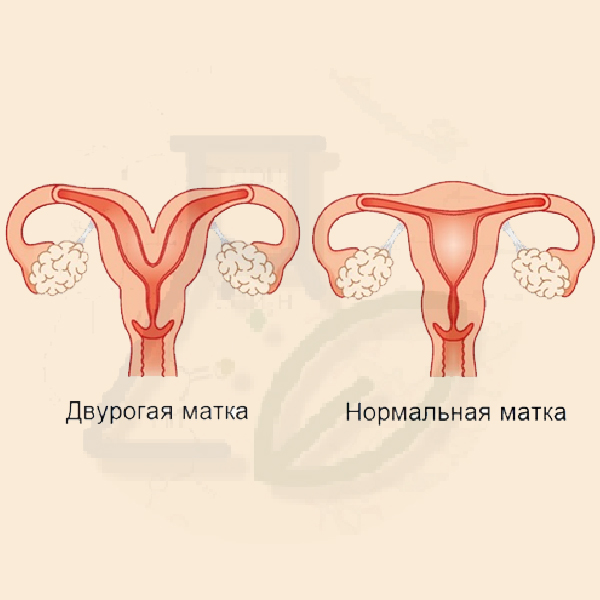 Двурогость матки