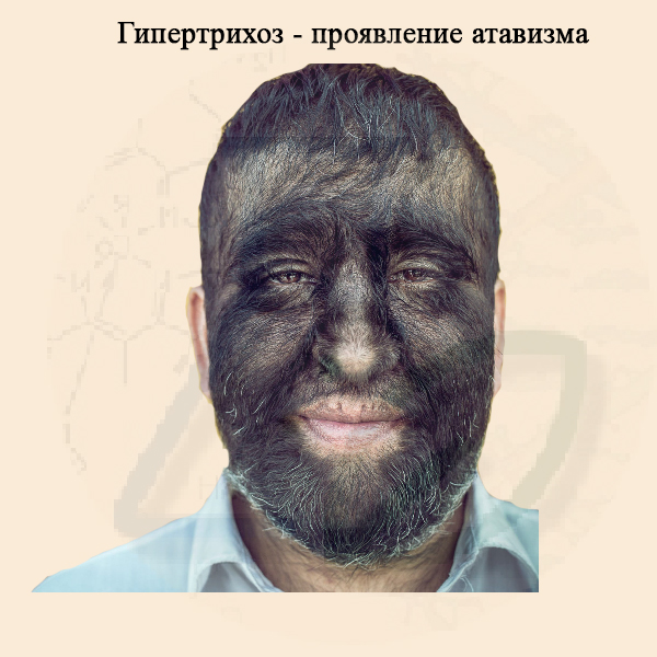 Гипертрихоз - атавизм
