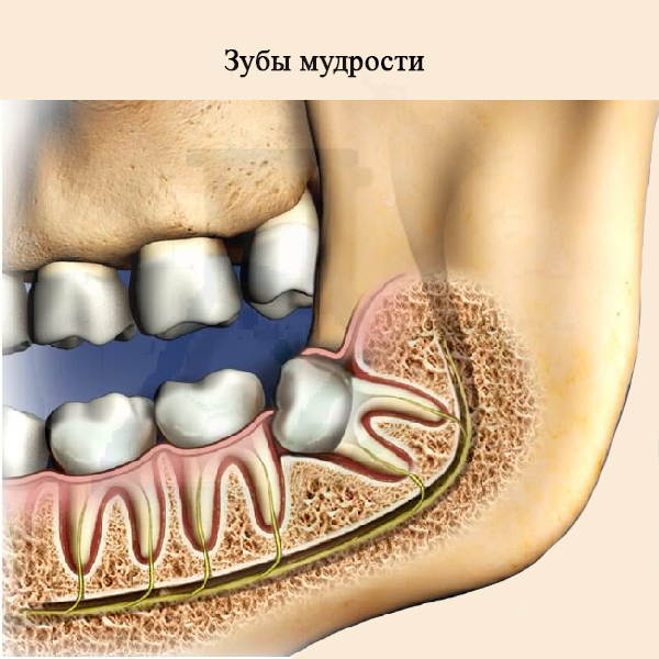 Зубы мудрости